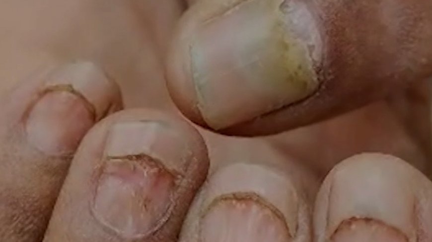 Sudden nail loss in Maharashtra's Buldhana